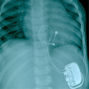 Obraz RTG klatki piersiowej